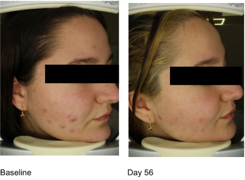 (其中一受試者,使用前vs使用後:臉部痘痘顯著改善。擷取自該報告FIGURE 6 (A))